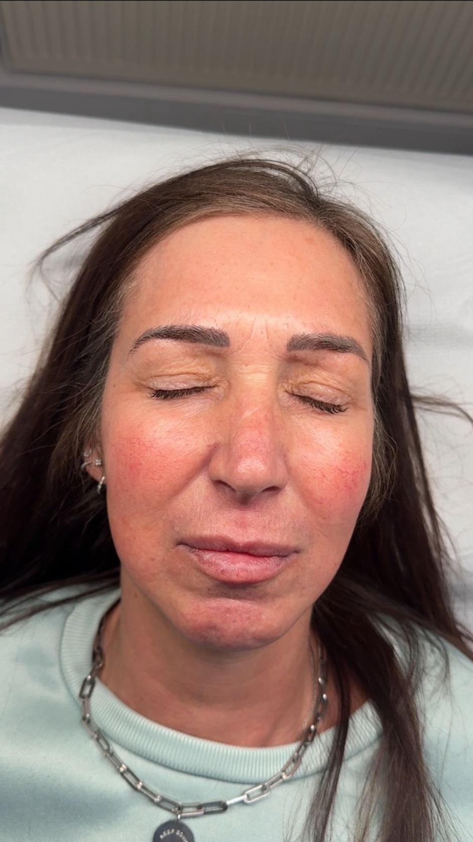 Anti-wrinkle treatment result