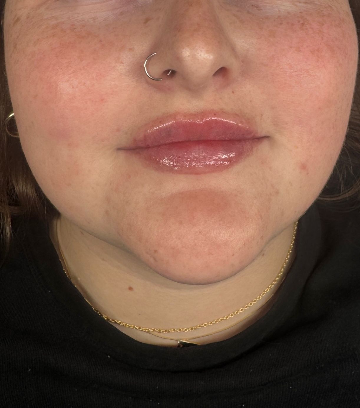 Dissolve and refill treatment
