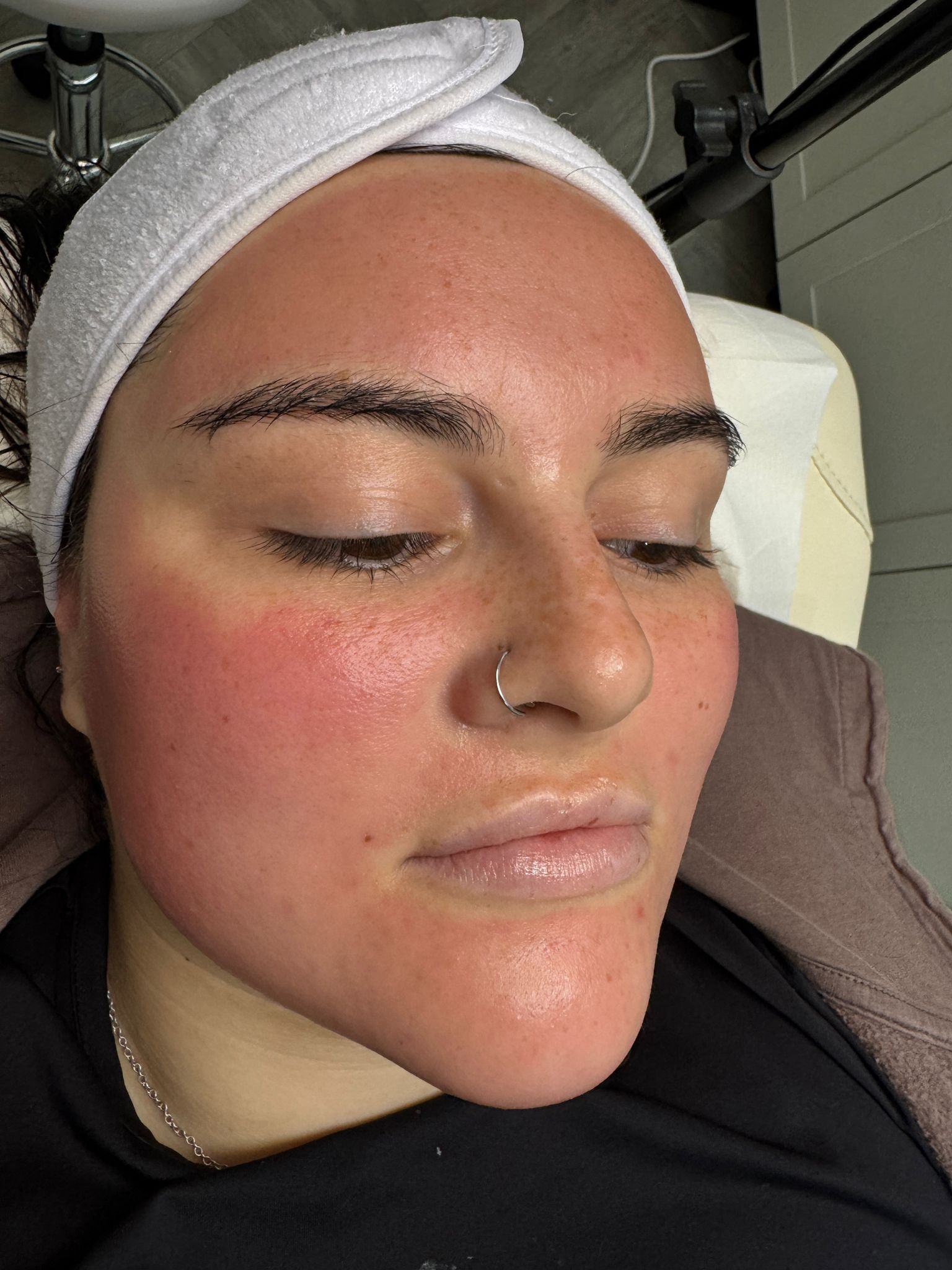 Dermaplaning facial treatment