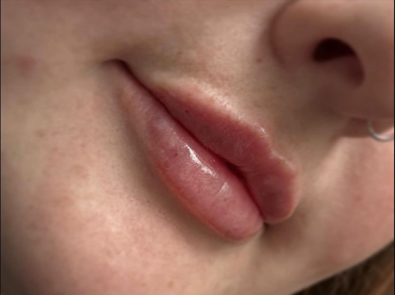 Lip fillers treatment result